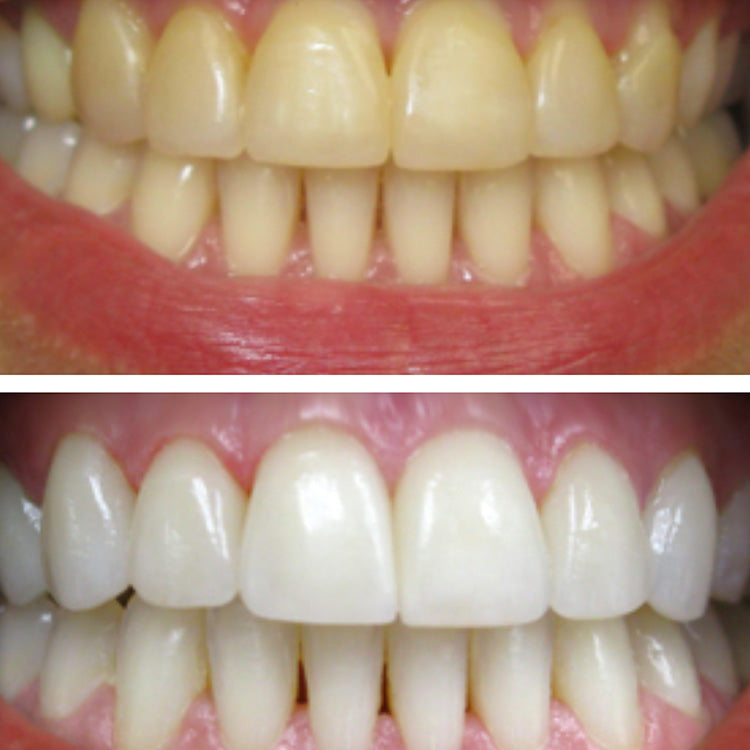 Teeth Whitening Booster Trio Before and After