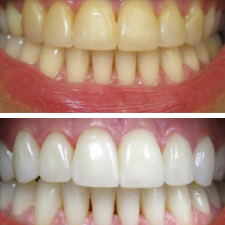 The Top Up Teeth Whitening Bundle Before and After