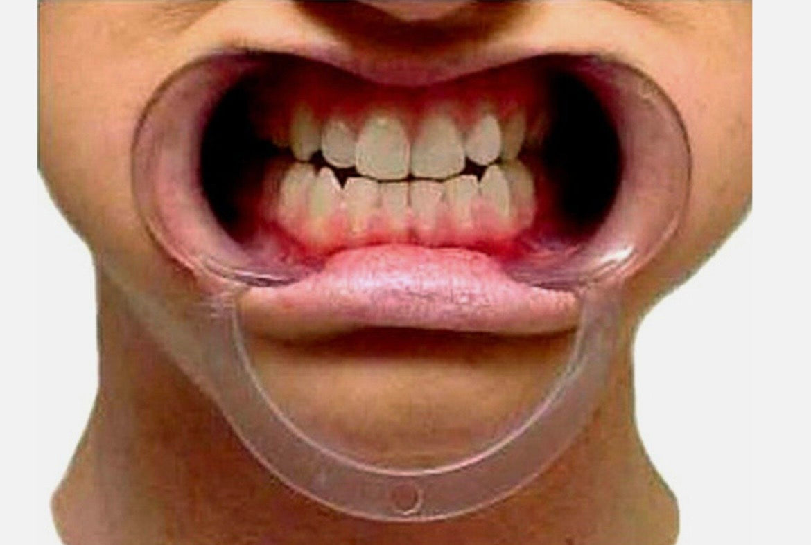 Teeth Whitening Cheek Retractor
